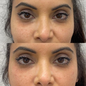 Before-and-After-Aptos-Thread-Lift