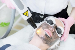 Before-and-after-Carbon-Laser-Facial