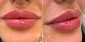 Before-and-After-Lip-Filler